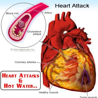 Heart attacks and hot water
